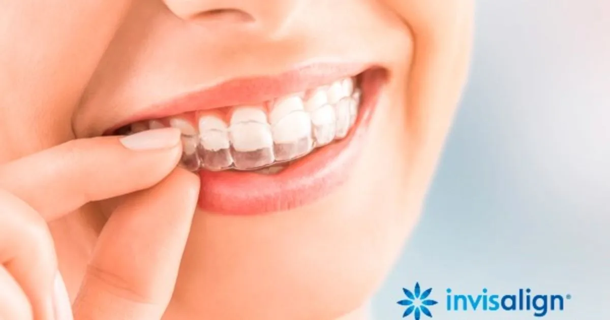 Alinhador Invisalign sendo posicionado no sorriso